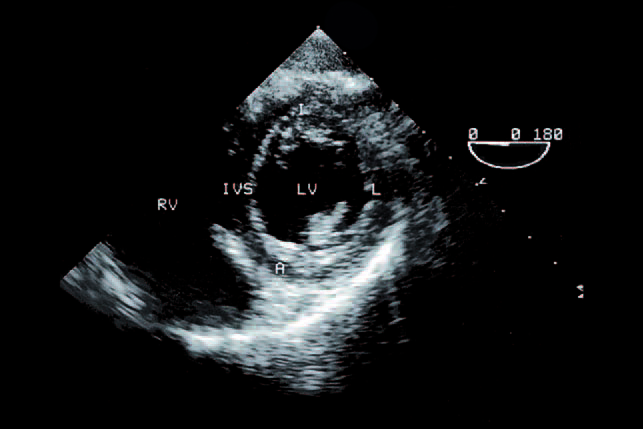 File:Parasternal Short Axis Mid Pap LV Schematic.png - Wikipedia