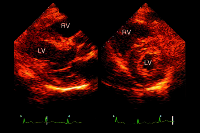 Speckle tracking echocardiography - Wikipedia